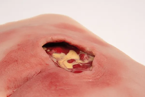 Wunmoulage sakraler Dekubitus, gesäubert
