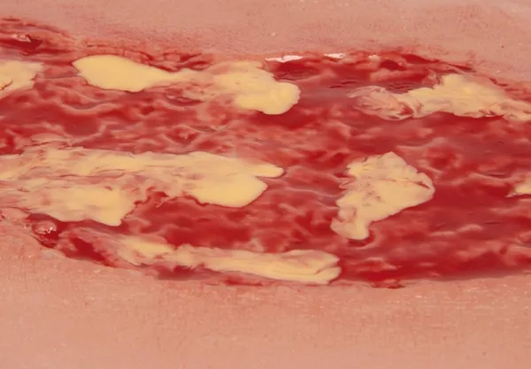 Wundmoulage Ulcus Cruris Venosum Exsudationsphase gross
