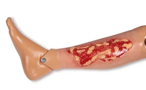 Wundmoulage Ulcus Cruris Venosum Exsudationsphase gross