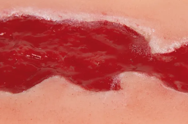 Wundmoulage Ulcus Cruris Venosum Granulationsphase klein