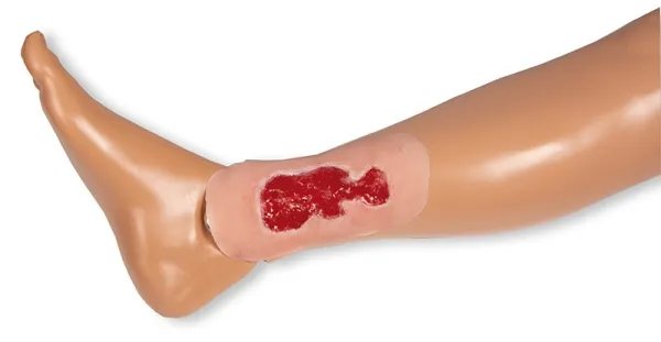Wundmoulage Ulcus Cruris Venosum Granulationsphase klein