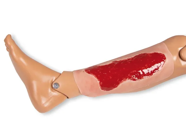 Wundmoulage Ulcus Cruris Venosum Granulationsphase gross