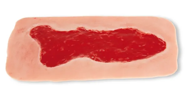 Wundmoulage Ulcus Cruris Venosum Granulationsphase gross