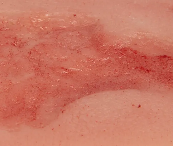 Wundmoulage Ulcus Cruris Venosum Epithelisierungsphase klein