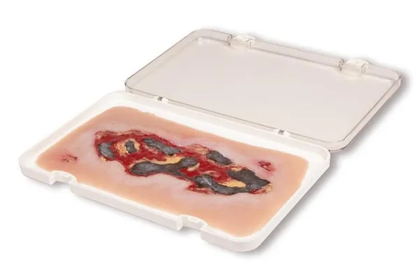 Wundmoulage Ulcus Cruris Arteriosum Exsudationsphase gross