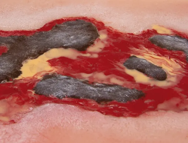 Wundmoulage Ulcus Cruris Arteriosum Exsudationsphase gross