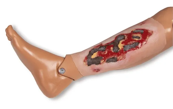 Wundmoulage Ulcus Cruris Arteriosum Exsudationsphase gross