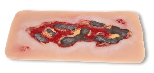 Wundmoulage Ulcus Cruris Arteriosum Exsudationsphase gross