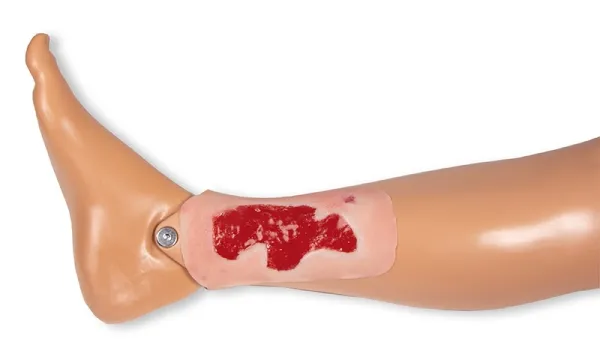 Wundmoulage Ulcus Cruris Arteriosum (Granulationsphase) klein