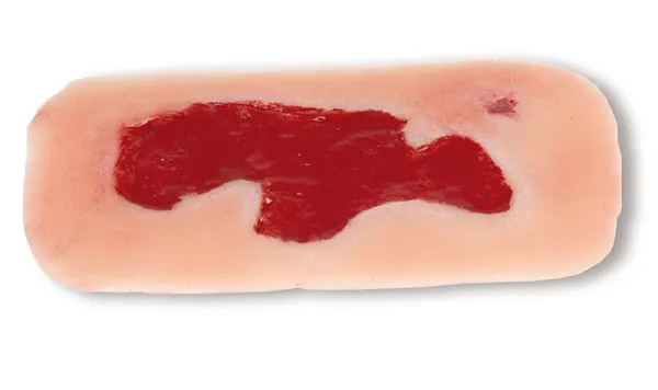Wundmoulage Ulcus Cruris Arteriosum (Granulationsphase) klein