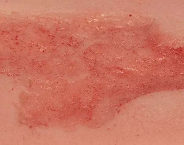 Wundmoulage Ulcus Cruris Arteriosum (Epithelisierungsphase) klein