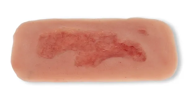 Wundmoulage Ulcus Cruris Arteriosum (Epithelisierungsphase) klein