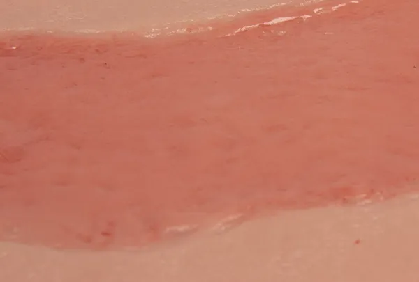 Wundmoulage Ulcus Cruris Arteriosum (Epithelisierungsphase) gross