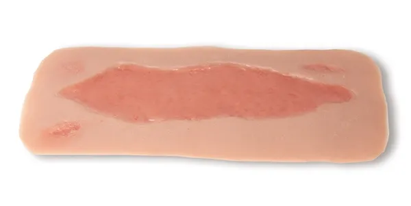Wundmoulage Ulcus Cruris Arteriosum (Epithelisierungsphase) gross