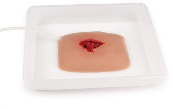 Wundmoulage wound packing