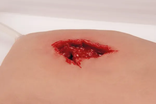 Wundmoulage wound packing