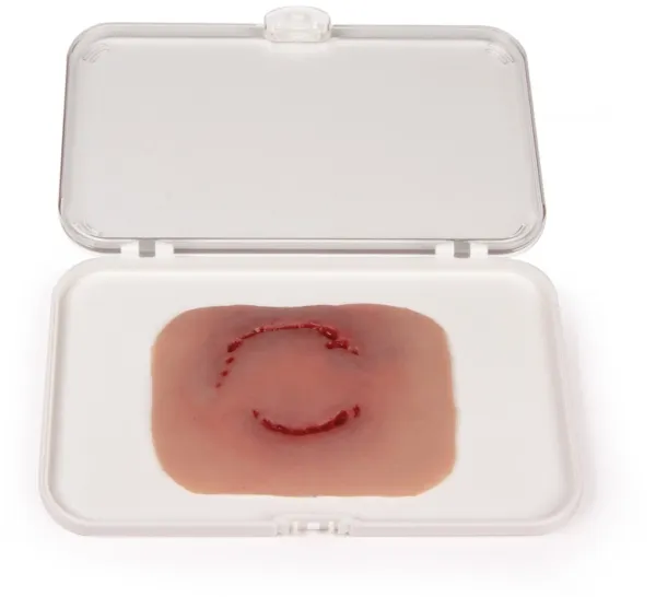 Wundmoulage Bisswunde Mensch
