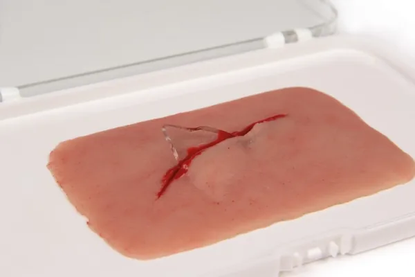Wundmoulage Schnittwunde mit Glassplitter