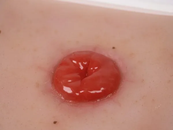 Wundmoulage Kolostoma, inkl. Stativ