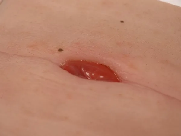 Wundmoulage Kolostoma in Bauchfalte, inkl. Stativ