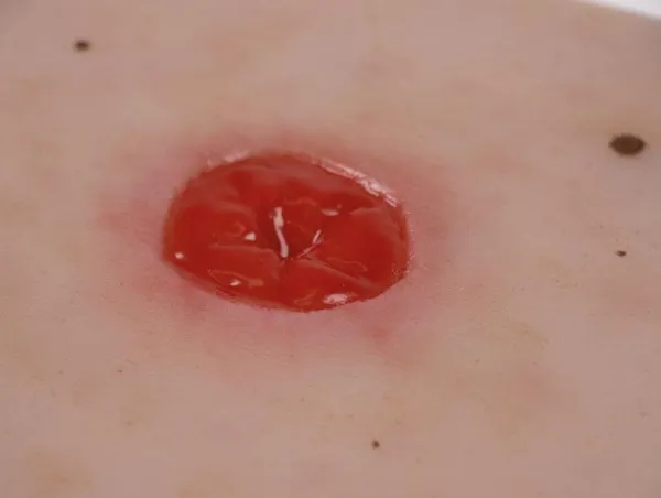 Wundmoulage Kolostoma unter Hautniveau, inkl. Stativ