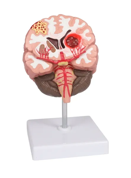 Pathologien des Gehirns, lebensgrösse