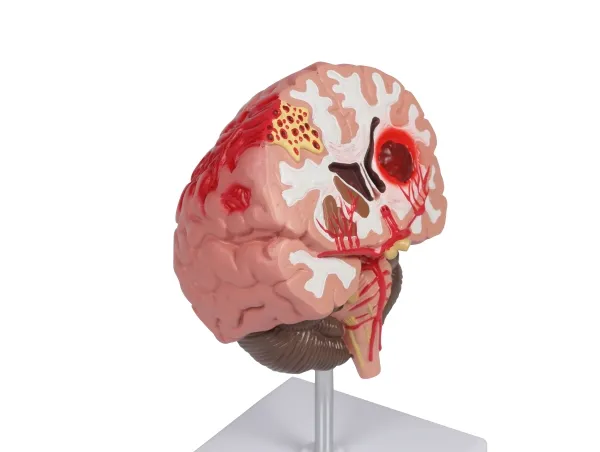 Pathologien des Gehirns, lebensgrösse
