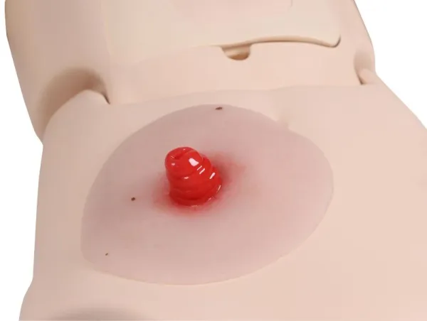 Wundmoulage Ileostoma, selbsthaftend