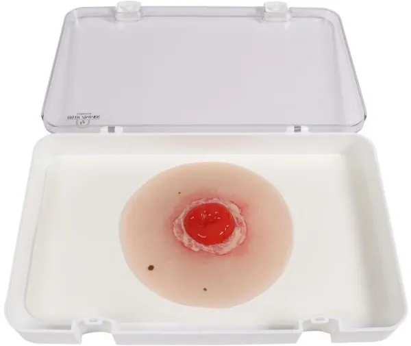 Wundmoulage Kolostoma entzündet, selbsthaftend