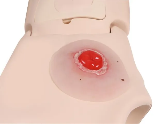 Wundmoulage Kolostoma entzündet, selbsthaftend