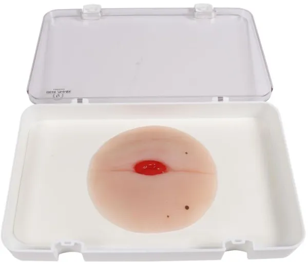 Wundmoulage Kolostoma in Bauchfalte, selbsthaftend