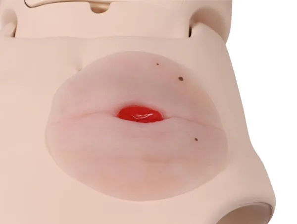 Wundmoulage Kolostoma in Bauchfalte, selbsthaftend
