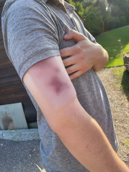Wundmoulage Hämatom frisch