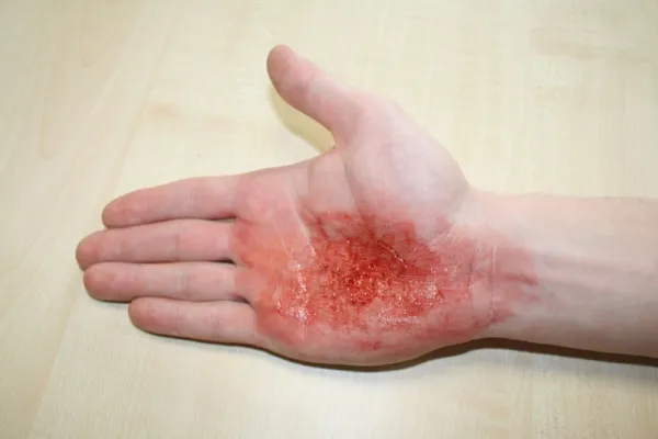 EZ Wounds – Wundensimulation Basic