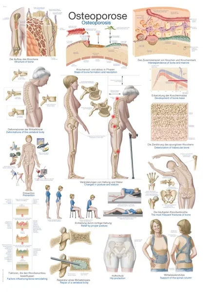 Lehrtafel &quote;Osteoporose&quote;, 70x100cm