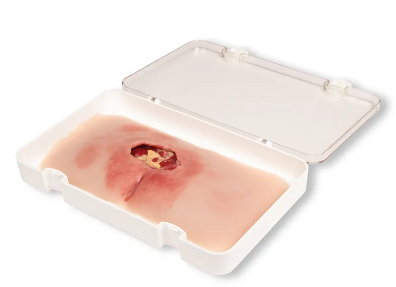 Wunmoulage sakraler Dekubitus, gesäubert