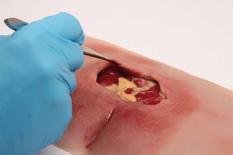 Wunmoulage sakraler Dekubitus, gesäubert