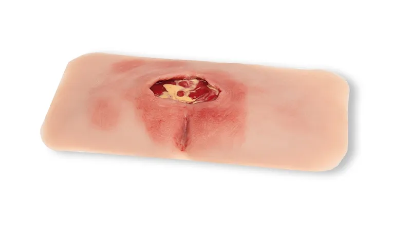 Wunmoulage sakraler Dekubitus, gesäubert