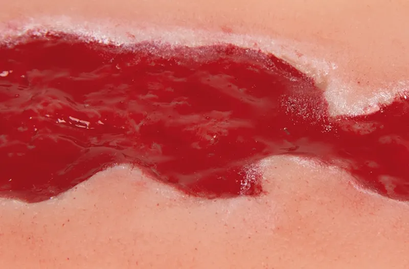 Wundmoulage Ulcus Cruris Venosum Granulationsphase klein