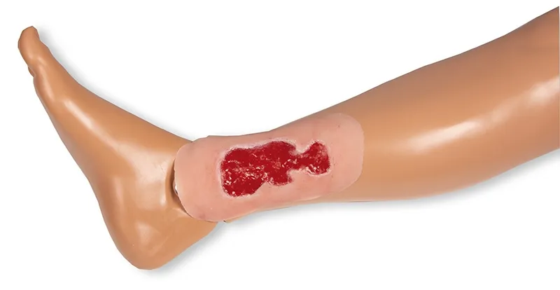 Wundmoulage Ulcus Cruris Venosum Granulationsphase klein