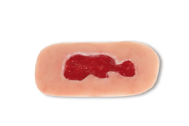 Wundmoulage Ulcus Cruris Venosum Granulationsphase klein
