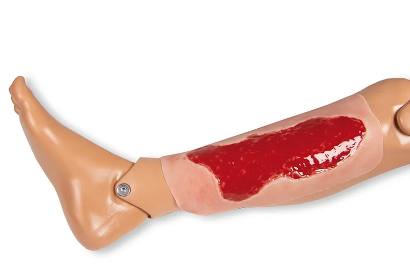 Wundmoulage Ulcus Cruris Venosum Granulationsphase gross