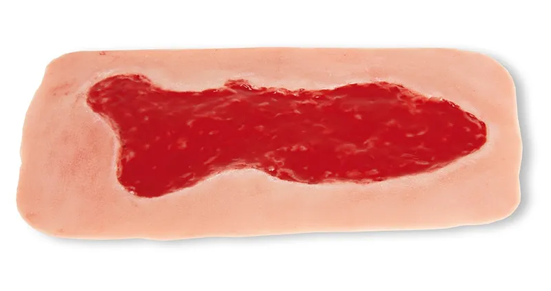 Wundmoulage Ulcus Cruris Venosum Granulationsphase gross