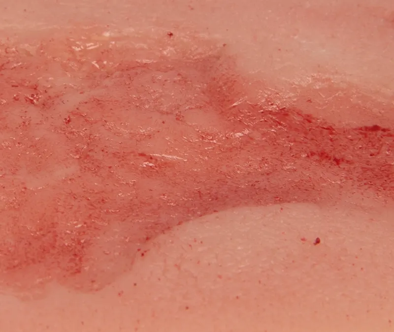 Wundmoulage Ulcus Cruris Venosum Epithelisierungsphase klein