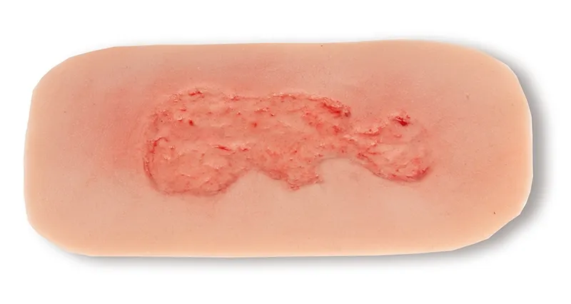 Wundmoulage Ulcus Cruris Venosum Epithelisierungsphase klein