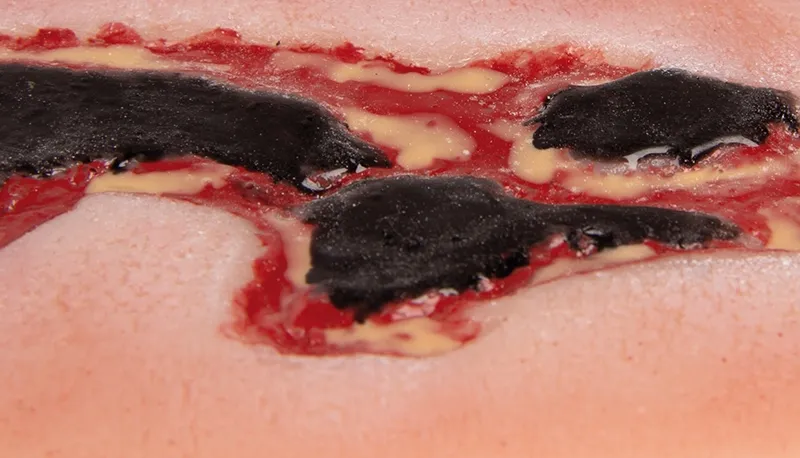 Wundmoulage Ulcus Cruris Arteriosum Exsudationsphase klein