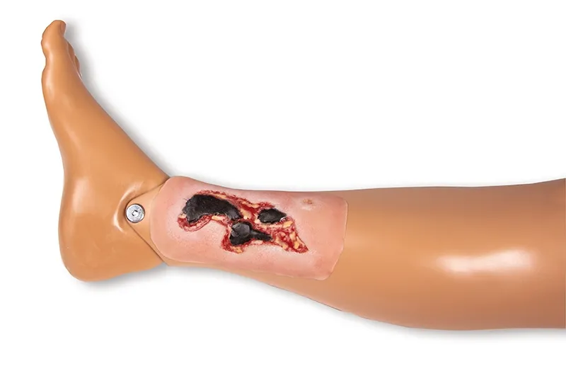 Wundmoulage Ulcus Cruris Arteriosum Exsudationsphase klein