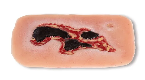 Wundmoulage Ulcus Cruris Arteriosum Exsudationsphase klein