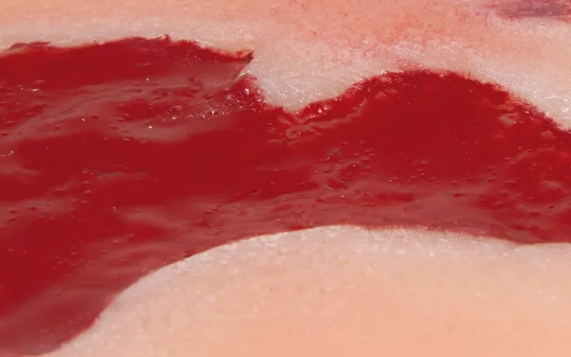 Wundmoulage Ulcus Cruris Arteriosum (Granulationsphase) klein