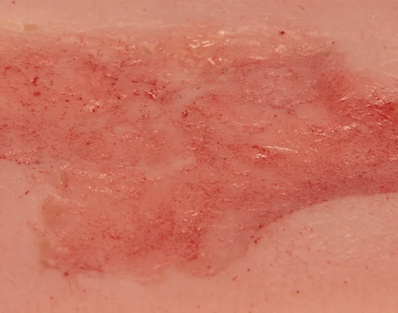 Wundmoulage Ulcus Cruris Arteriosum (Epithelisierungsphase) klein